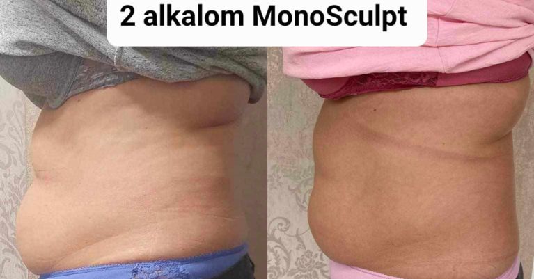 Monosculpt alakformálás és zsírbontás