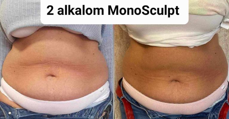 Monosculpt alakformálás és zsírbontás