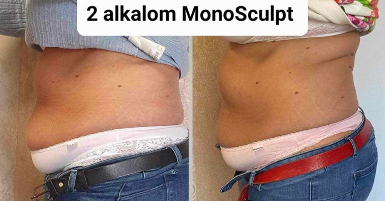 Monosculpt alakformálás és zsírbontás