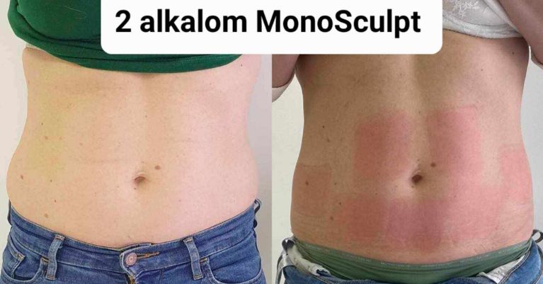 Monosculpt alakformálás és zsírbontás