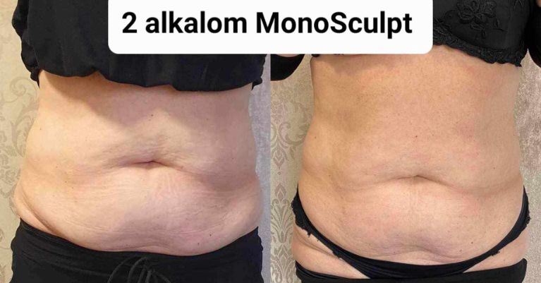 Monosculpt alakformálás és zsírbontás
